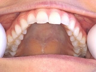 Top Teeth