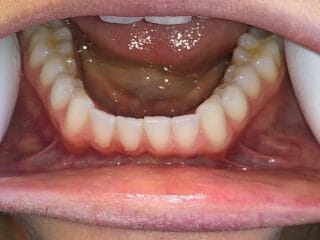 Bottom Teeth