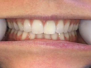 Bottom Teeth