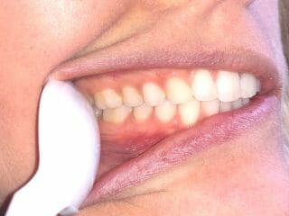 Bottom Teeth