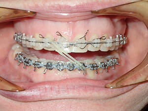 https://www.westervillebraces.com/wp-content/uploads/2020/05/billmideline2.jpg