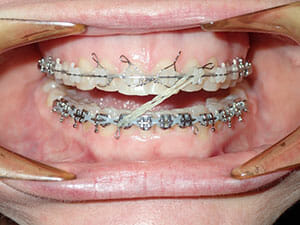 Elastics on braces