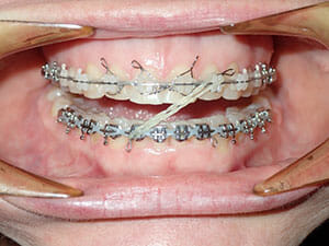 https://www.westervillebraces.com/wp-content/uploads/2020/05/billmideline3.jpg