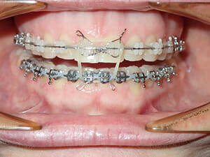 https://www.westervillebraces.com/wp-content/uploads/2020/05/box-elliot2.jpg