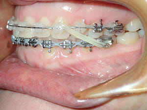 https://www.westervillebraces.com/wp-content/uploads/2020/05/class2-1.jpg