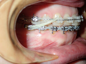 https://www.westervillebraces.com/wp-content/uploads/2020/05/class2-2.jpg