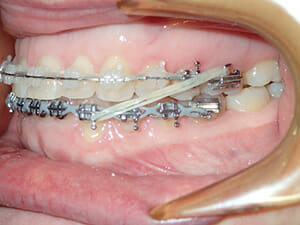 Class III Elastics on braces