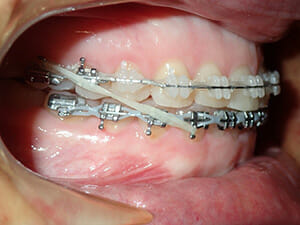 https://www.westervillebraces.com/wp-content/uploads/2020/05/class3-2.jpg