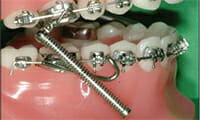 https://www.westervillebraces.com/wp-content/uploads/2020/05/forsus.jpg