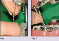https://www.westervillebraces.com/wp-content/uploads/2020/05/forsus2.jpg