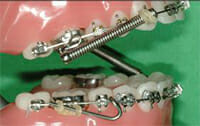 https://www.westervillebraces.com/wp-content/uploads/2020/05/forsus3.jpg