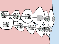 Illustration of how to fix loose brackets