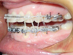 https://www.westervillebraces.com/wp-content/uploads/2020/05/m-greg2.jpg