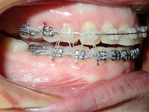 https://www.westervillebraces.com/wp-content/uploads/2020/05/m-greg3.jpg