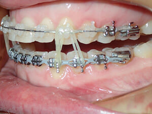 https://www.westervillebraces.com/wp-content/uploads/2020/05/v-louis2.jpg