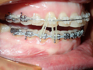 https://www.westervillebraces.com/wp-content/uploads/2020/05/v-louis3.jpg