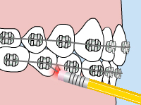 Illustration of how to fix wire irritation on braces 