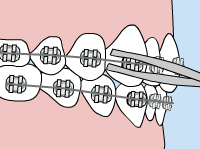 Illustration of how to fix wire irritation on braces 