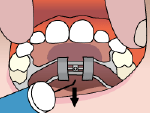Illustration of removing the key in a palatal expander 