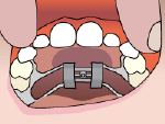 Illustration of a palatal expander 
